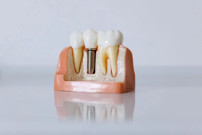 Modelo de implante dentário de titânio — implantes na CT Odonto, Graças, Recife