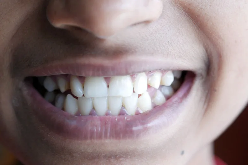 Sorriso com gengiva saudável — tratamento de periodontia na CT Odonto, Graças, Recife